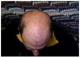 Baldness