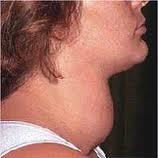 Goiter